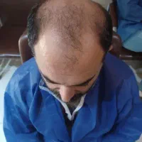 کاشت مو|خدمات آرایشگری و زیبایی|تبریز, |دیوار