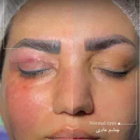 جراحی بلفارو پلاستی نیم بها|خدمات زیبایی و سلامت|تهران, فیروزآبادی|دیوار