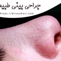 راهنمایی عمل زیبایی بینی