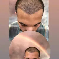 کاشت مووابروبه بدون جراحی ودردوبصورت اقساطی|خدمات آرایشگری و زیبایی|تبریز, |دیوار