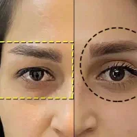 بلفارو (بخیه لیزری) ،دایرکت ابرو، ساکشن غبغب