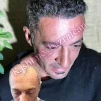 کاشت مو تکنسین شیرازی در تبریز