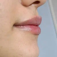 فیلر لب نچرال|خدمات آرایشگری و زیبایی|رشت, بلوار گیلان|دیوار
