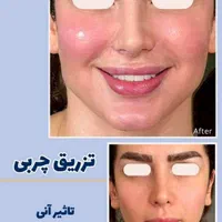 تزریق فیلر بادی ،ساکشن، تزریق چربی صورت و بدن|خدمات آرایشگری و زیبایی|صدرا-فارس, |دیوار
