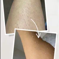 لیزر موهای زائد