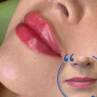 (کلینیک زیبایی) فیلر،بوتاکس مزوژل جوانساز، ضدلک|خدمات آرایشگری و زیبایی|قشم, |دیوار