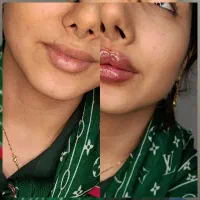 آموزش فیلر چونه بوتاکس ژل لب مزوژل پرسینگ|خدمات آرایشگری و زیبایی|مشهد, موسوی قوچانی|دیوار