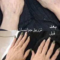 ژل لب،بوتاکس،زاویه سازی توسط پزشک|خدمات آرایشگری و زیبایی|تهران, صادقیه|دیوار