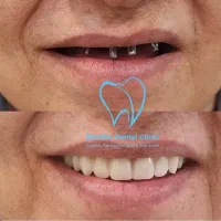 هر۴واحد ایمپلنت دیجیتال+1ایمپلنت رایگان/کاشت دندان|خدمات آرایشگری و زیبایی|تهران, فرمانیه|دیوار