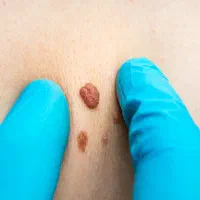 فریز زگیل ( بالوکە )|خدمات آرایشگری و زیبایی|بوکان, |دیوار