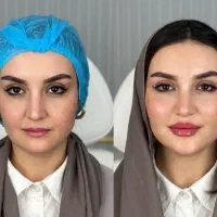 تزریق ژل و بوتاکس و مزو پزشک متخصص و مجرب