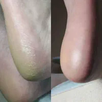 درمان و رفع ترک پا در یک جلسه vip