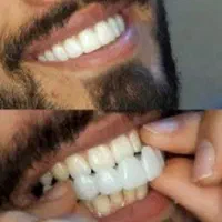 لمینت متحرک دندان|آرایشی، بهداشتی، درمانی|سنندج, |دیوار