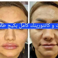 ژل بوتاکس فیلر نخ فشیال صورت
