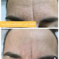 کوچک کردن بینی ورفع پف چشم بدون عمل جراحی|خدمات آرایشگری و زیبایی|مشهد, کوثر|دیوار