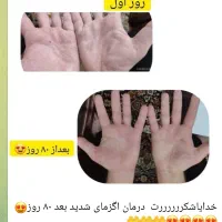 اگزما سردی وخشکی پوست