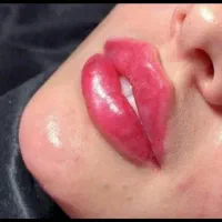 (کلینیک زیبایی) فیلر،بوتاکس مزوژل جوانساز، ضدلک|خدمات آرایشگری و زیبایی|قشم, |دیوار