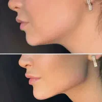 تخفیفات باور نکردین ژل،بوتاکس،آنزیم ،چال گونه|خدمات آرایشگری و زیبایی|کرمانشاه, |دیوار