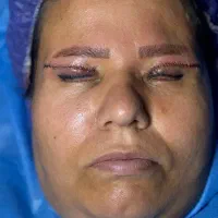 جشنواره بلفاروپلاستی جراحی پلک با بخیه لیزری|خدمات آرایشگری و زیبایی|تهران, شهرک غرب|دیوار