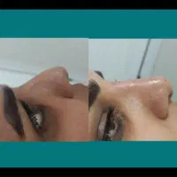 انواع خدمات ژل بوتاکس انزیم تخفیف ویژه|خدمات آرایشگری و زیبایی|کوهدشت, |دیوار