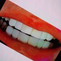 دندانسازی کامپوزیت،لمینیت(قیمت توتوضیحات)ژل بوتاکس