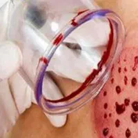 آموزش کارگاهی صفر تا صدحجامت و زالو درمانی|خدمات آموزشی|ارومیه, |دیوار