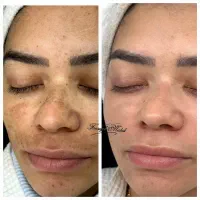 حذف تک جلسه ای لک و کک مک کلینیک|خدمات آرایشگری و زیبایی|رشت, گلسار|دیوار