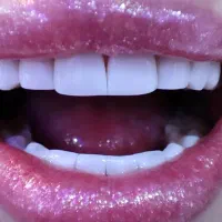 دندانپزشکی کامپوزیت و ایمپلنت و عصب کشی