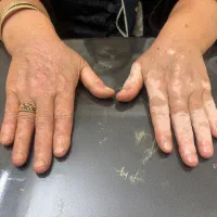 اولین مرکز تخصصی کاموفلاژ ویتیلیگو درغرب کشور