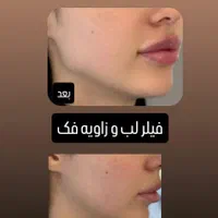 تزریق ژل وبوتاکس با بهترین قیمت در برازجان