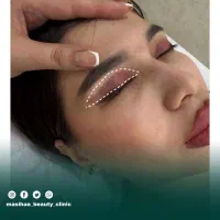 بلفاروپلاستی اقساطی