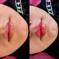 فیلر لب روسی عروسکی|خدمات آرایشگری و زیبایی|سلماس, |دیوار