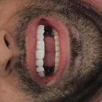 کامپوزیت ایمپلنت ارتودنسی   بندرعباس