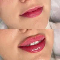 تزریق ژل بوتاکس لیزر هایفو مزو پی ار پی نخ فیشیال|خدمات آرایشگری و زیبایی|شهریار, |دیوار