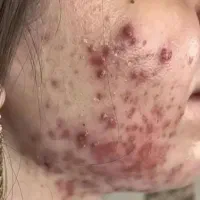 فیشال و خدمات پوستی در کلینیک|خدمات آرایشگری و زیبایی|اسلامآباد غرب, |دیوار