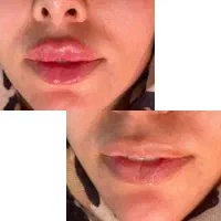 مادلینگ صورت باپک ده سی سی فقط 7/900 فیلربوتاکس ژل