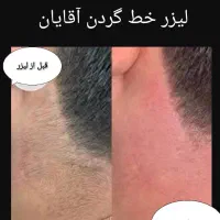 لیزرمو خانم300آقا600ریموتتوخال ژل بوتاکس لک پوستی|خدمات آرایشگری و زیبایی|نجف‌آباد, ویلاشهر|دیوار