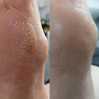 پدیکور کلینیکال درمانی