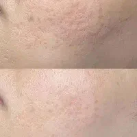 پاکسازی و جوانسازی پوست با تجهیزات پیشرفته|خدمات آرایشگری و زیبایی|رشت, گلسار|دیوار