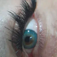 کاشت مژه( هیدن)