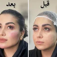 ساکشن تخلیه و تزریق چربی