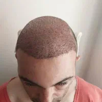 کاشت مو و ابرو در میانه|خدمات آرایشگری و زیبایی|میانه, |دیوار