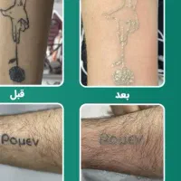 پاک کردن تتو ابرو بدن|خدمات آرایشگری و زیبایی|مشهد, نوید|دیوار