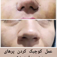 آفر ژل وبوتاکس مزو