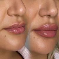 تخفیف ویژه ژل ۸۹۹ بوتاکس ۷۹۹