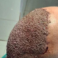 اموزش کاشت مو