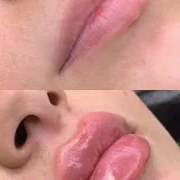 تخفیف پاییزی بوتاکس و فیلر