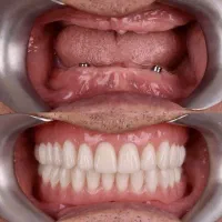 کاشت دندان دو فک فقط ۱۰۰ میلیون در تبریز