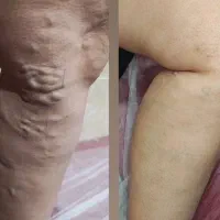 درمان یکی از علل مهم درد اندام