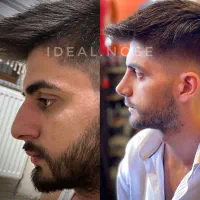 جشنواره عمل زیبایی بینی با تخفیف ویژه|خدمات آرایشگری و زیبایی|الوند, |دیوار